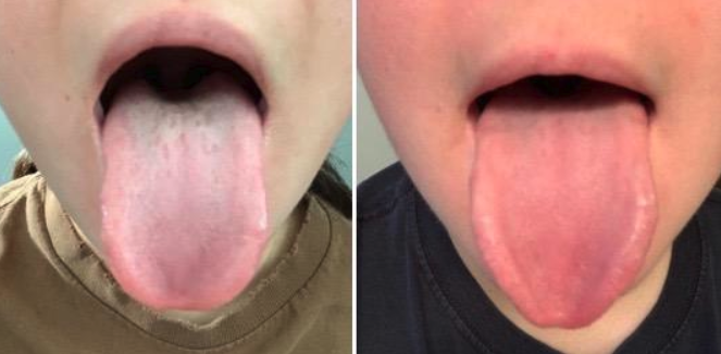 before/after image of reviewer&#x27;s tongue. the after pic shows less build-up on tongue