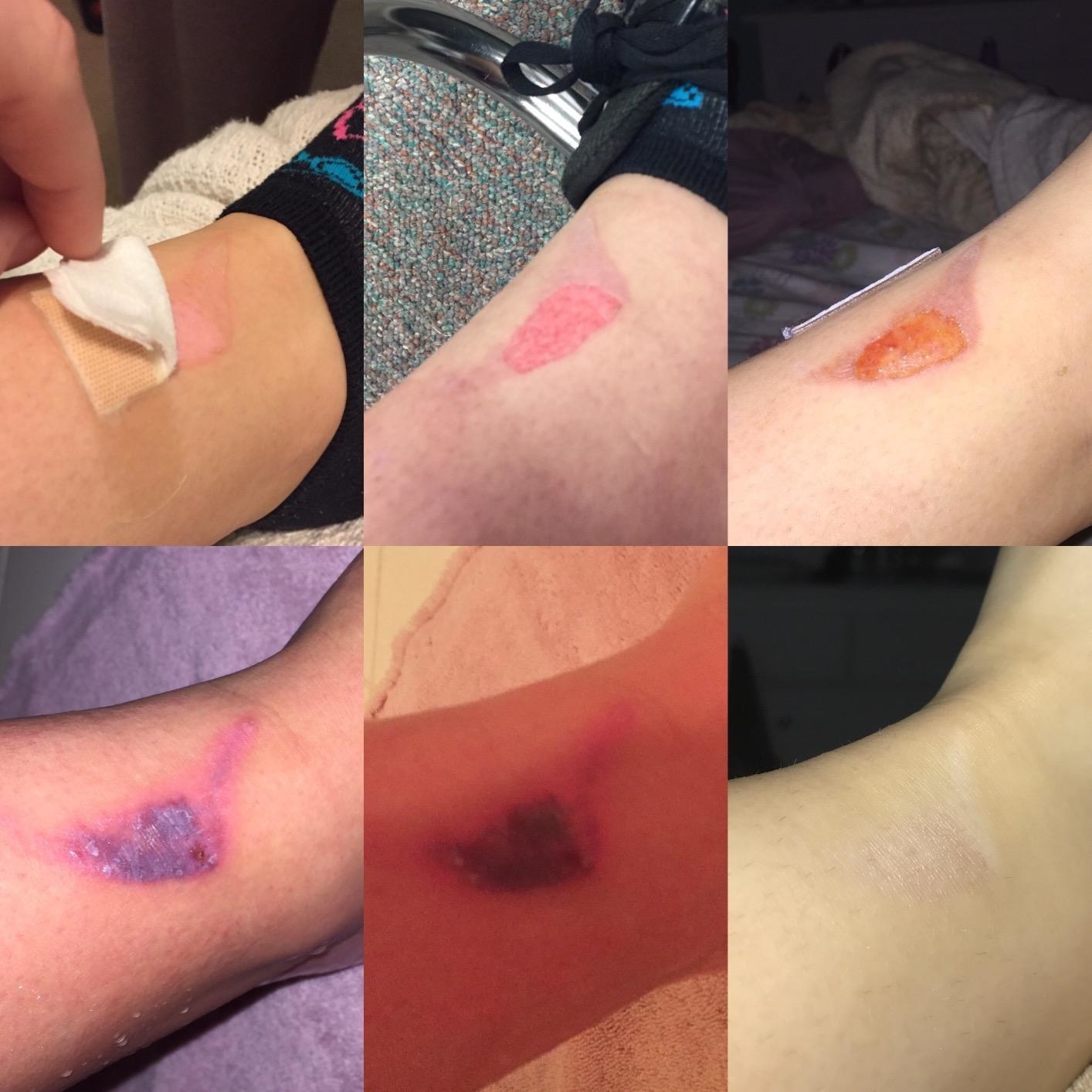 six images of a review&#x27;s injury scabbing over and almost completely disappearing 
