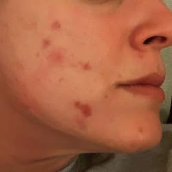 a reviewer showing their acne covered face