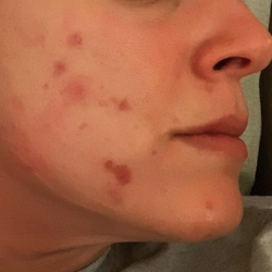 a reviewer's face covered in acne