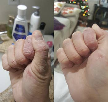 left: severely peeling hand right: hand with less peeling 