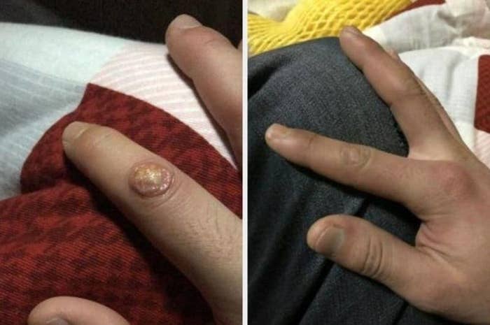 On the left, a wart on a reviewer&#x27;s finger, and on the right, the same reviewer&#x27;s finger now completely clear of the wart