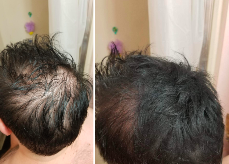 A reviewer&#x27;s before and after photo of them using the hair-building fibers to cover some bald spots