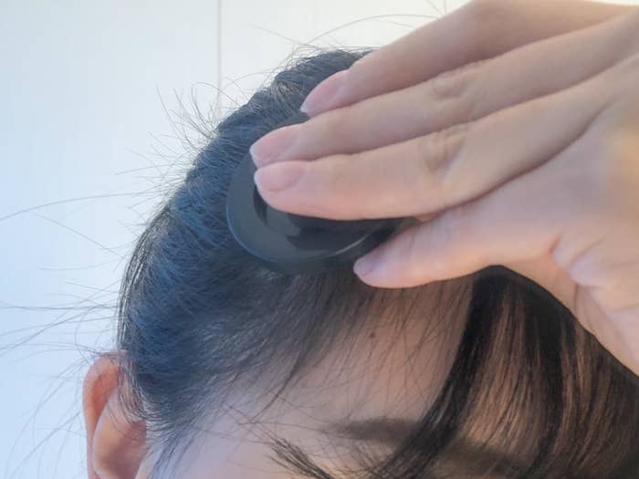 50+ グレア M 字はげ 生まれつき - 今日は楽しかった