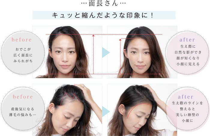 50+ グレア M 字はげ 生まれつき - 今日は楽しかった