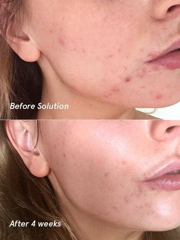 A before/after of a model showing reduced acne and acne marks