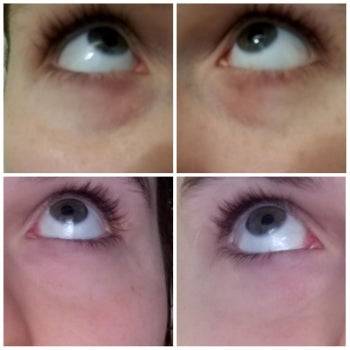 reviewer shows before and after of under eye bags looking lighter and less swollen 
