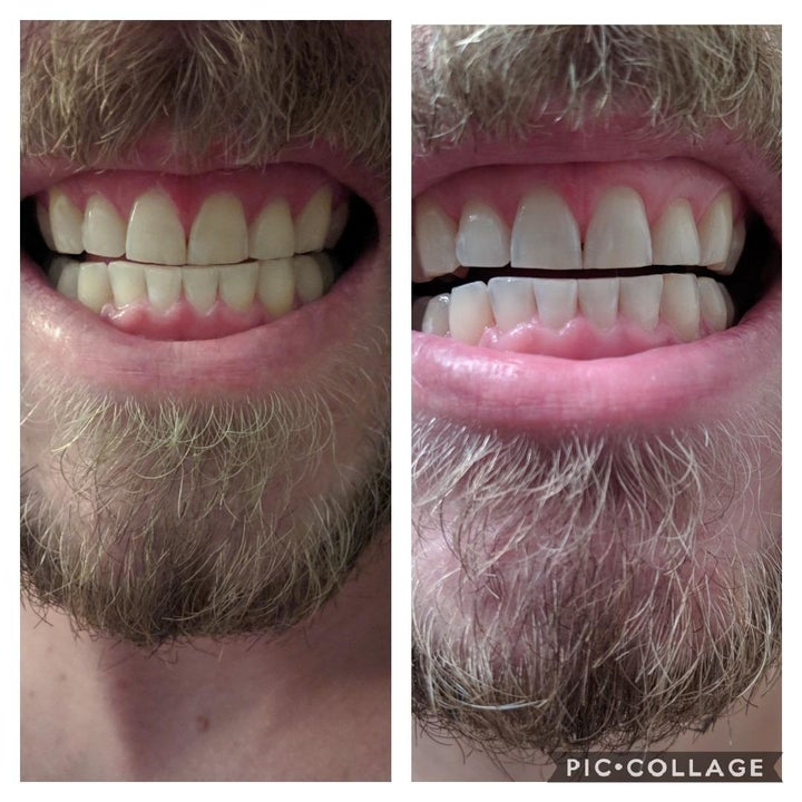 Another reviewer's before and after showing the kit noticeably whitened their teeth