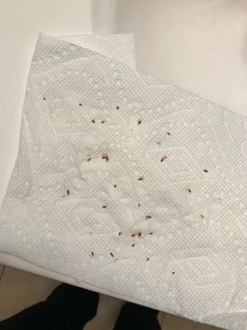 Reviewer photo of ticks removed after using shampoo