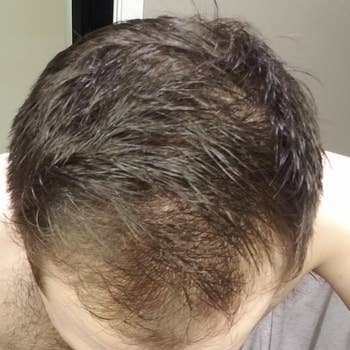 Top down image of reviewer showing signs of hair thinning