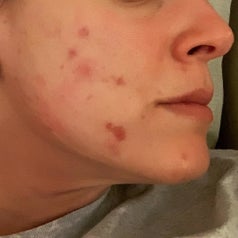 Reviewer photo of cheeks with dark red acne scars and breakouts