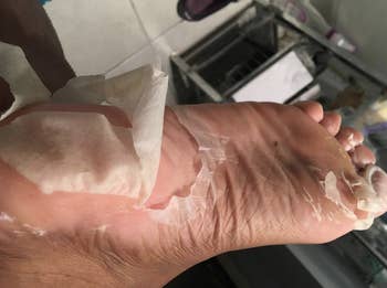 reviewer's feet with a chunk of dead skin peeling from it