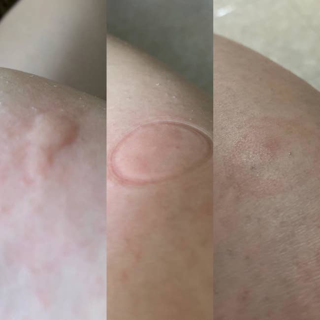 A reviewer's bug bite in three images: the bite, the bite immediately after using the tool with a circular mark, and after with reduced swelling