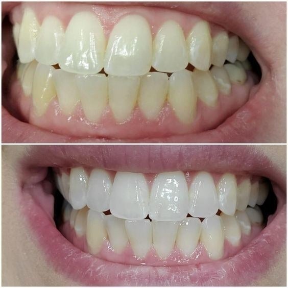 reviewer before and after photos with shinier, whiter teeth 