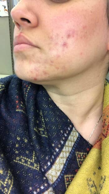 The same reviewer with healed and reduced acne