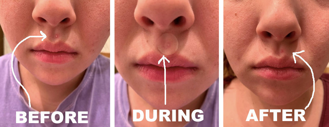 a before, during, and after series of images showing the reviewer using the patch and their pimple diminishing