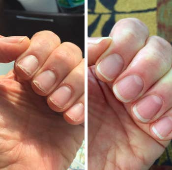 Reviewer with severely chipped, weak nails stronger and healthier after use 