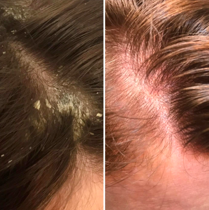 Before and after of reviewer&#x27;s scalp. First with flakes and scales from dandruff and then clean and healthy after use. 