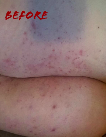 Back of person's legs covered in razor burn, ingrown hairs, and irritated bumps