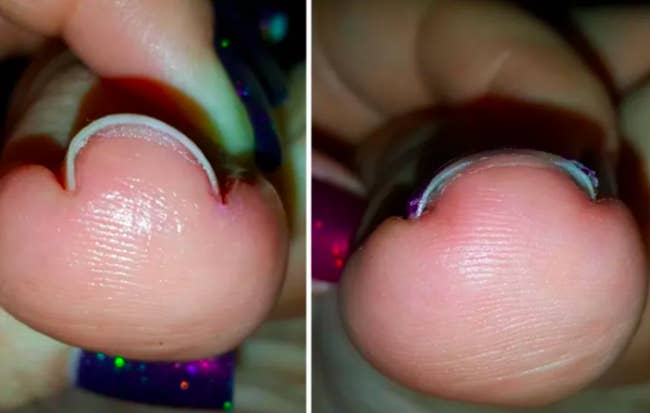 U-curved toenail cutting deep into skin elongated and leveled after using brace 