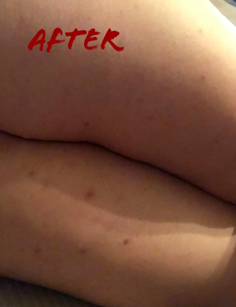 The same legs without the redness or excessive bumps, with a few minor dark scars left 