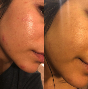 a reviewer showing a before and after of their skin looking more clear