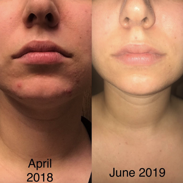 a reviewer's before and after photos showing how nice their skin looks after using the product for two months