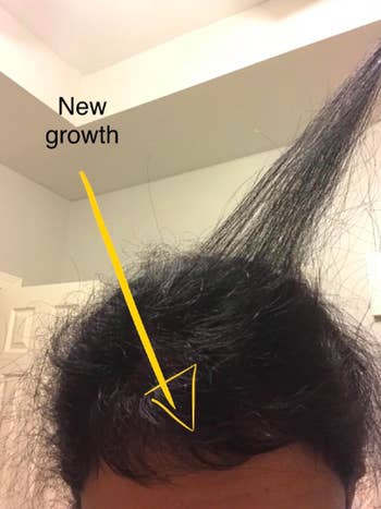 A reviewer showing new hair growth after consistently using the scalp brush