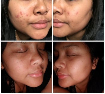 before and after of reviewer, showing acne scars, then smooth, acne-free skin after use of product