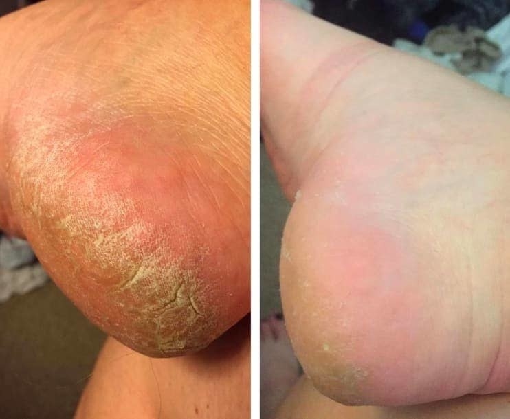 A reviewer showing their cracked feet now looking softer and smoother after using the sleeves