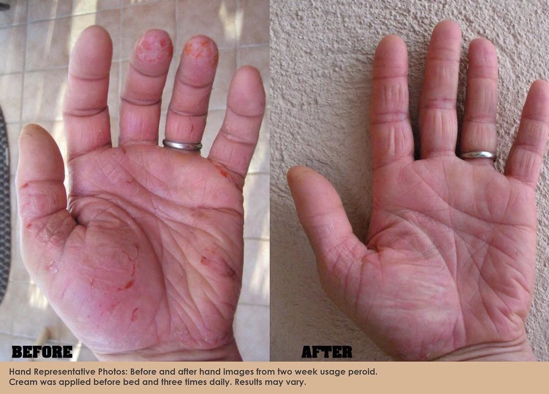 Before: a hand that&#x27;s cracked and red from dryness; after, the same hand, with no more cracks