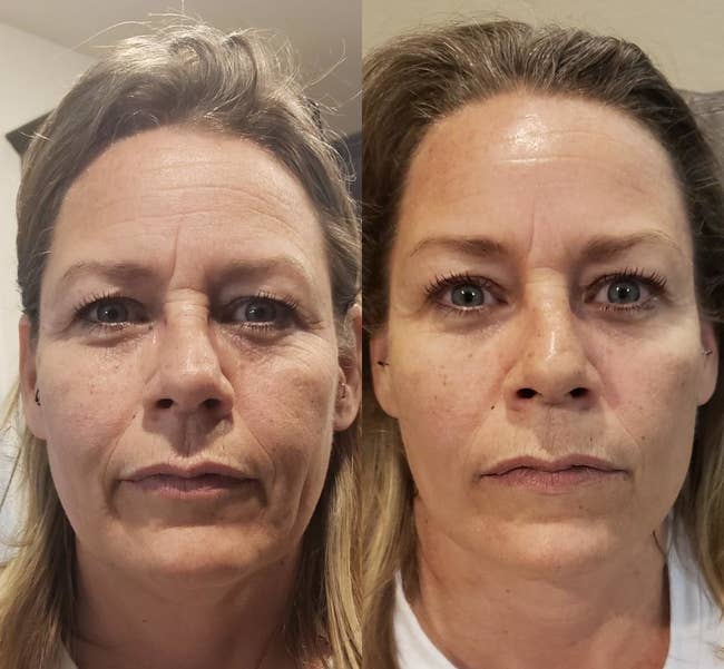 Before of reviewer with forehead wrinkles, puffy eye bags, and crow's feet next to after photo of same reviewer with less noticeable wrinkles and tighter-looking skin.