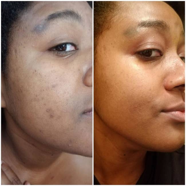 A split photo of a face with some breakouts and the same face with the breakouts gone. 