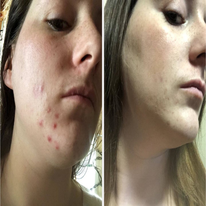 reviewer's before and after of hormonal acne clearing up after using the aztec clay multiple times a week