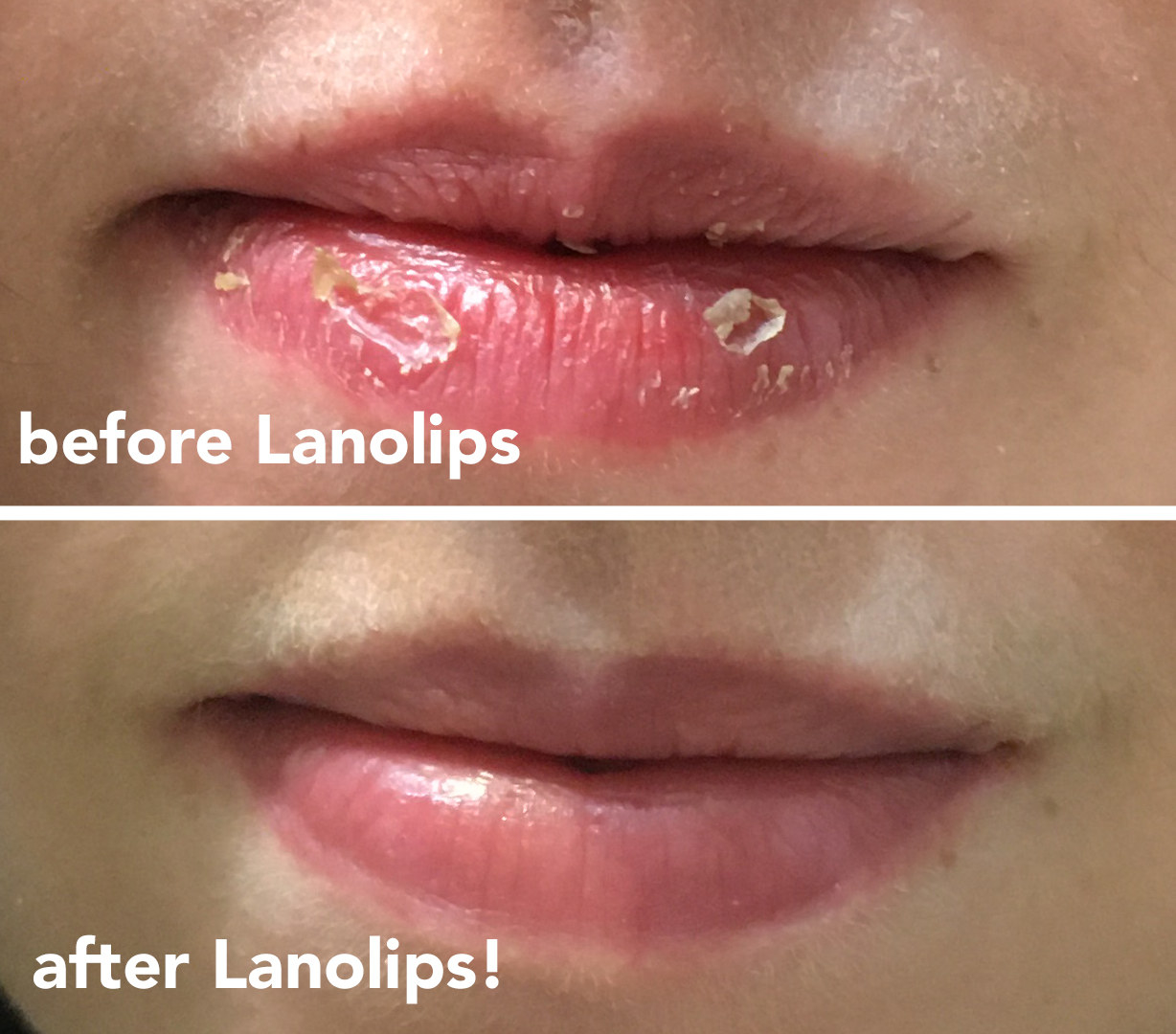on top, a buzzfeed editor&#x27;s dry cracked lips, on the bottom the same lips looking healed and smooth
