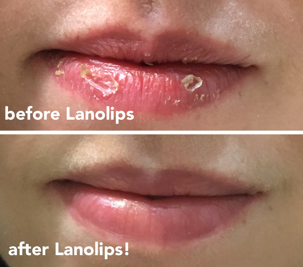 on the top a BuzzFeed editor&#x27;s chapped lips labeled &quot;before lanolips&quot;, on the bottom the same lips looking smooth labeled &quot;after lanolips&quot;