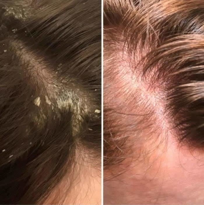 on the left a reviewer&#x27;s scalp with a lot of dandruff, on the right the same scalp with no dandruff