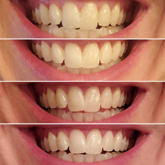 a series of photos showing a reviewer's teeth looking more white and clean with continued use of the toothpaste