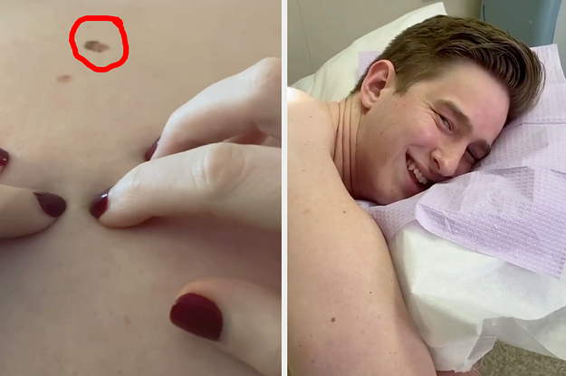 TikTok Users Noticed A Weird Looking Mole On A Guy's Back In A Video. His Doctor Said They Probably Saved His Life