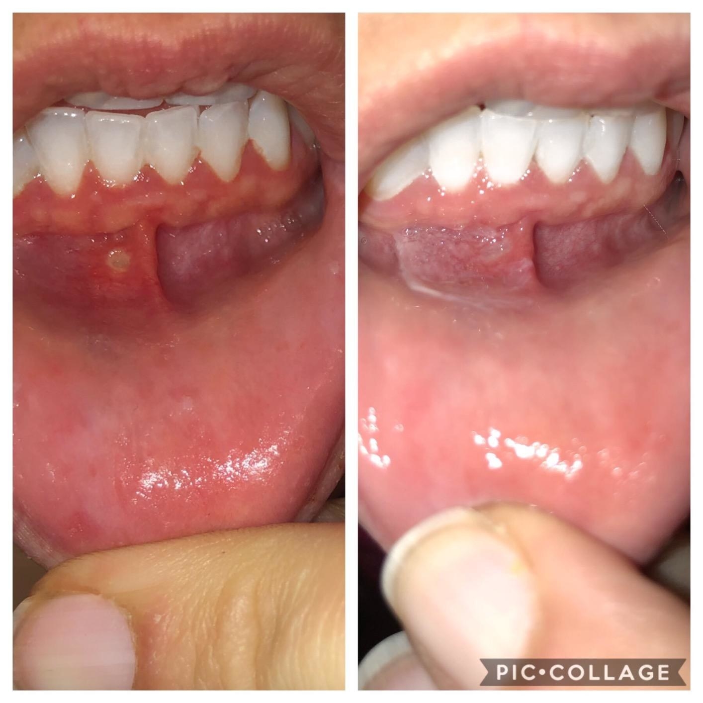 left: reviewer shoes canker sore on gum right&quot; canker sore is almost entirely gone 