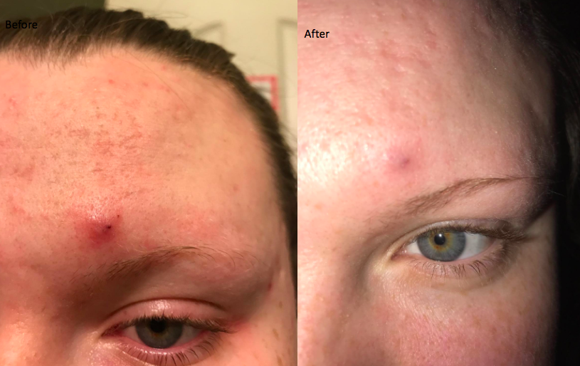 reviewer with angry looking pimple on forehead, then the same reviewer with it flattened out and healing
