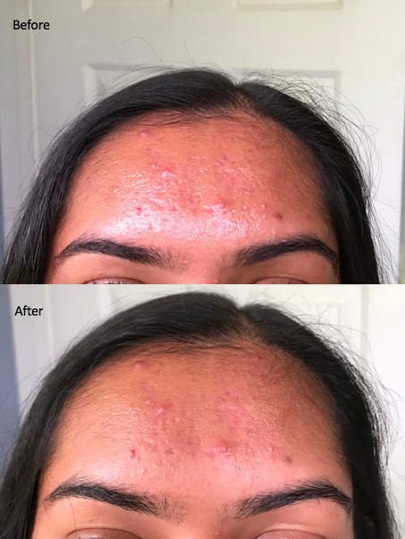 A customer review photo showing their forehead before and after using the blotting papers