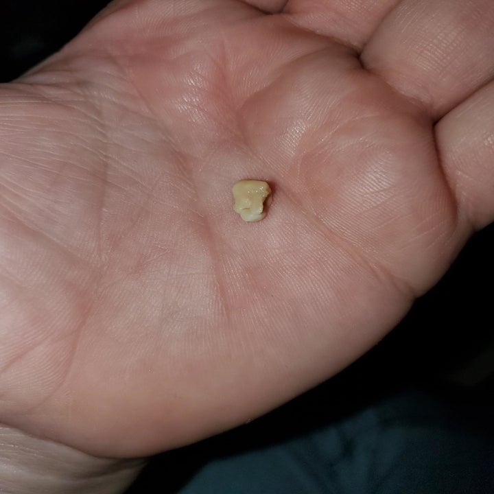 Reviewer holding a tonsil stone they removed using the kit