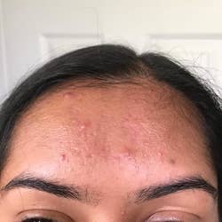 the same reviewer's forehead after using the sheets, showing it's much less oily