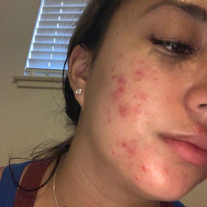 A face with acne on the cheeks and chin. 