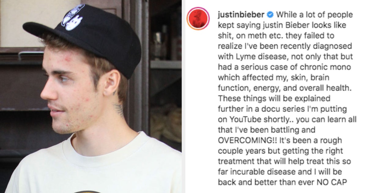 Justin Bieber Revealed His Lyme Disease Diagnosis And Had A Message For ...