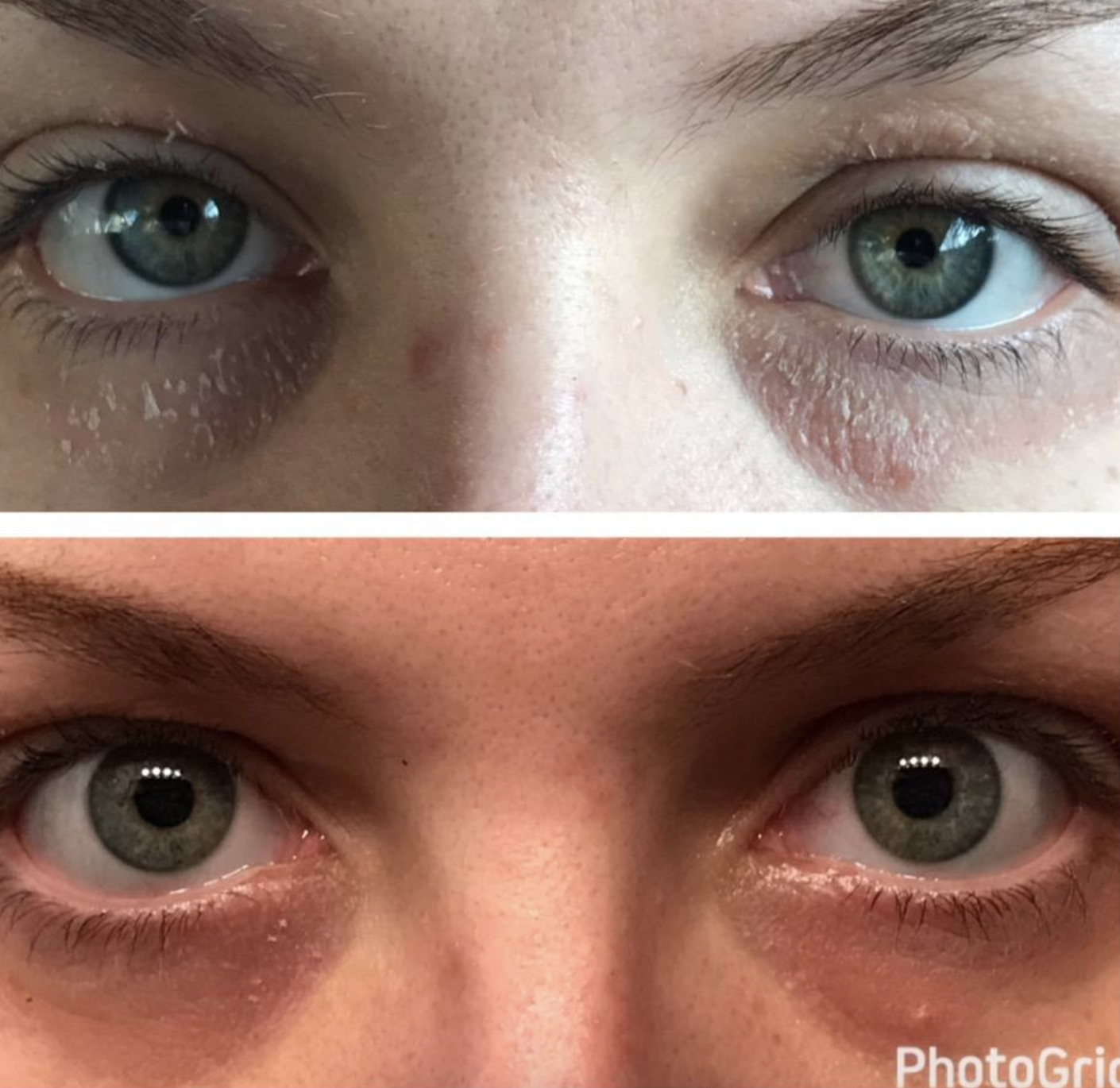 reviewer&#x27;s before/after showing super dry skin under eyes and the after pic with noticeably less dry skin