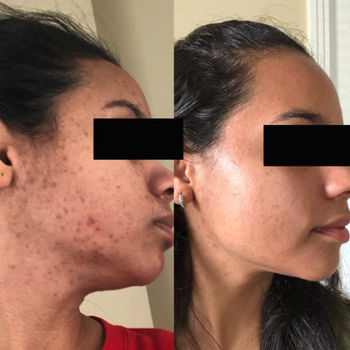 before image showing reviewers acne scars and after photo showing clearer skin with less scarring