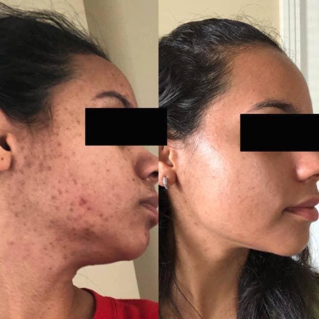 reviewer before/after pic with before photo showing acne scars and after photo with significantly less scarring and dark spots