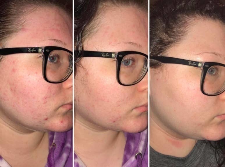 reviewer pic of cheek with painful looking breakouts, then with the same cheek healing up, then the same cheek completely clear 